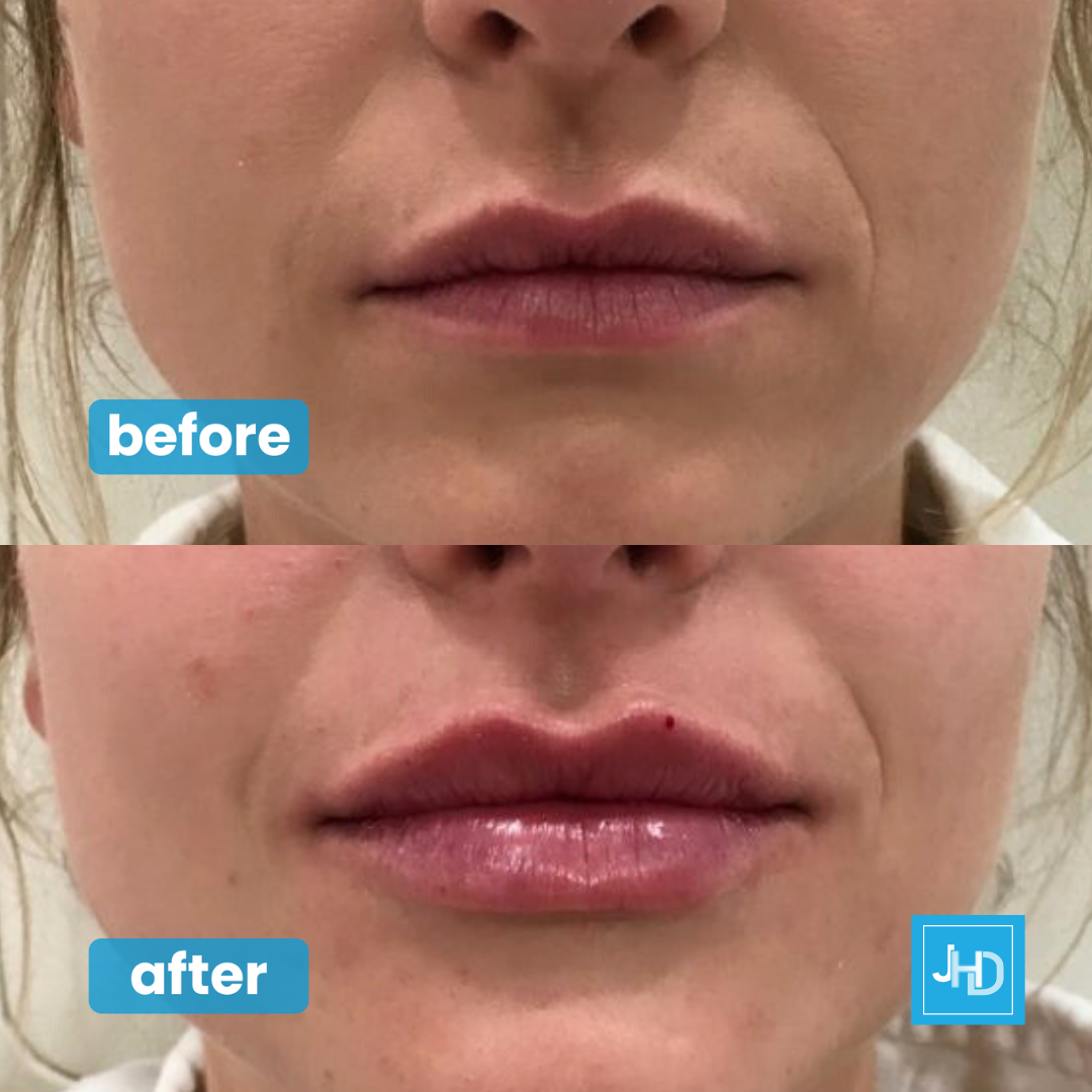 Dermal Lip Filler Treatment Facial Aesthetics Swaffham Kings Lynn